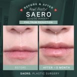 Before and after philtrum reduction results at SAERO Plastic Surgery, improved lip contour