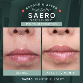 Before and after philtrum reduction results at SAERO Plastic Surgery, improved lip contour