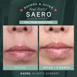Before and after philtrum reduction results at SAERO Plastic Surgery, improved lip contour