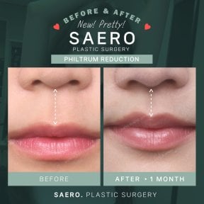 Before and after philtrum reduction results at SAERO Plastic Surgery, 1 month post-op