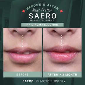 Before and after philtrum reduction results at SAERO Plastic Surgery, visible lip enhancement