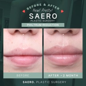 Before and after philtrum reduction results at SAERO Plastic Surgery, improved lip contour