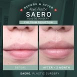 Before and after philtrum reduction results at SAERO Plastic Surgery, improved lip contour