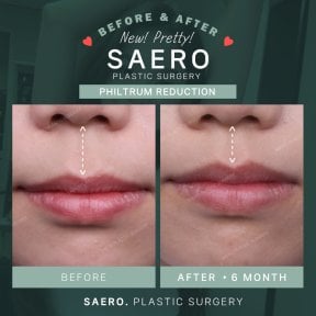 Before and after philtrum reduction results at SAERO Plastic Surgery, 6 months post-op