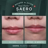 Before and after philtrum reduction results at SAERO Plastic Surgery, 6 months post-op