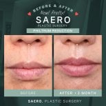 Before and after philtrum reduction results at SAERO Plastic Surgery – improved lip contour