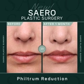 Before and after philtrum reduction results at SAERO Plastic Surgery, 1 month post-op