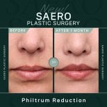 Before and after philtrum reduction results at SAERO Plastic Surgery, 1 month post-op
