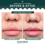 Before and after philtrum reduction results at SAERO Plastic Surgery, lip lift improvement