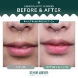 Before and after philtrum reduction results at SAERO Plastic Surgery, improved lip contour