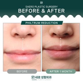 Before and after philtrum reduction results at SAERO Plastic Surgery, 1 month post-procedure
