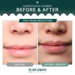 Before and after philtrum reduction results at SAERO Plastic Surgery, 1 month post-procedure