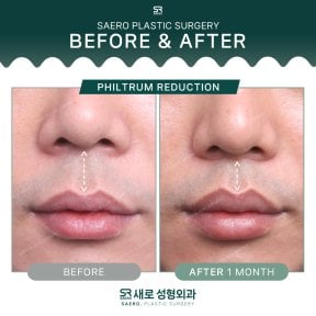 Before and after philtrum reduction results at SAERO Plastic Surgery, improved lip contour