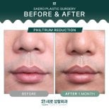 Before and after philtrum reduction results at SAERO Plastic Surgery, improved lip contour