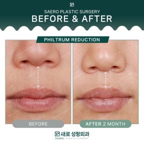 Before and after philtrum reduction results at SAERO Plastic Surgery, improved lip contour