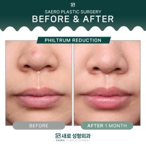 Before and after philtrum reduction results at SAERO Plastic Surgery, improved lip contour