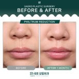 Before and after philtrum reduction results at SAERO Plastic Surgery, improved lip contour
