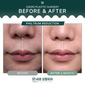 Before and after philtrum reduction results at SAERO Plastic Surgery, improved lip contour