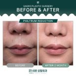Before and after philtrum reduction results at SAERO Plastic Surgery, improved lip contour