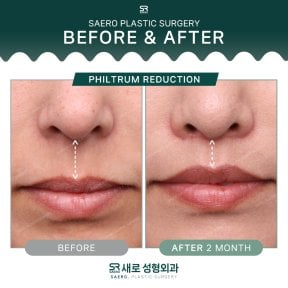 Before and after philtrum reduction results at SAERO Plastic Surgery, improved lip contour
