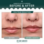 Before and after philtrum reduction results at SAERO Plastic Surgery, improved lip contour