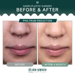 Philtrum reduction before and after results at SAERO Plastic Surgery, improved lip contour