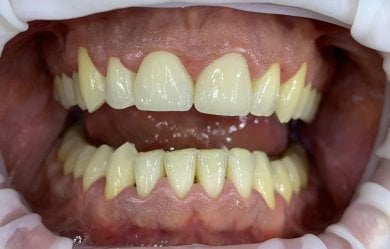 before-after photo installation-of-a-veneer