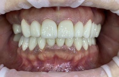 before-after photo installation-of-a-veneer
