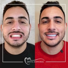 before-after photo all-on-6-dental-implants