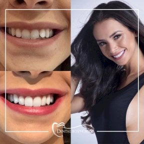 before-after photo dental-implant
