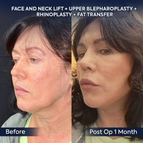 before-after photo deep-plane-facelift
