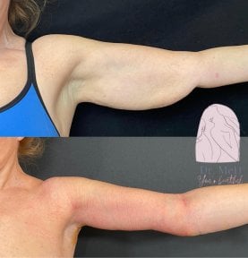 before-after photo liposuction