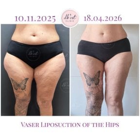 before-after photo vaser-liposuction