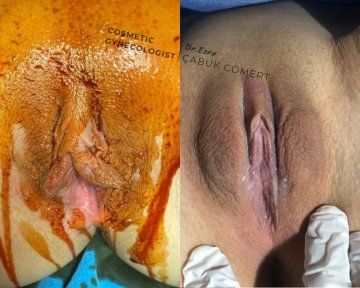 before-after photo labiaplasty