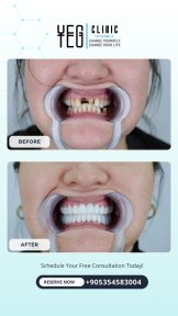 before-after photo all-on-6-dental-implants