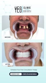 before-after photo all-on-6-dental-implants