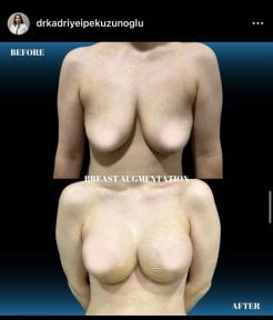 before-after photo mommy-makeover