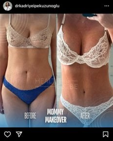 before-after photo mommy-makeover