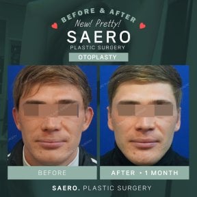 Результати отопластики до і після в SAERO Plastic Surgery, покращена форма вух у чоловіка