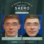 Результати отопластики до і після в SAERO Plastic Surgery, покращена форма вух у чоловіка
