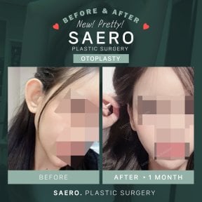 Результати отопластики до і після в SAERO Plastic Surgery – помітне покращення форми вуха