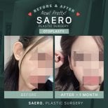 Результати отопластики до і після в SAERO Plastic Surgery – помітне покращення форми вуха
