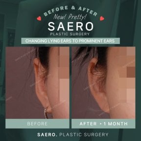 Результати отопластики до і після в SAERO Plastic Surgery – покращення форми вух