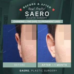 Результати отопластики до і після в SAERO Plastic Surgery, покращення форми вух