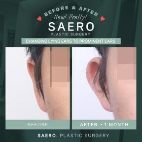 Результати отопластики до і після в SAERO Plastic Surgery – покращення форми вух