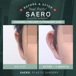 Результати отопластики до і після в SAERO Plastic Surgery – покращення форми вух