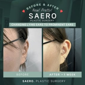Отопластика до і після в SAERO Plastic Surgery – покращення форми вух за 1 тиждень