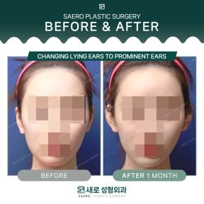 Результати отопластики до і після в SAERO Plastic Surgery – природна форма вух