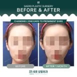 Результати отопластики до і після в SAERO Plastic Surgery – природна форма вух