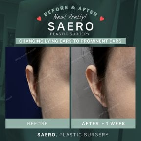 Результати отопластики в SAERO Plastic Surgery – корекція вух через 1 тиждень